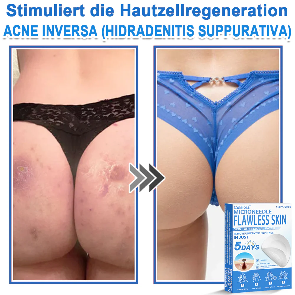 ✅ Celsiora® 2-in-1 Mikronadel- & Hydrokolloid-Pflaster | Entferner für erhabene Muttermale, Akne, flache Warzen & Hautanhängsel | Verbessert Falten, Narben & Hautunreinheiten | Unsichtbare Stern-Pickelpflaster für Gesicht & Körper✨ - Image 10