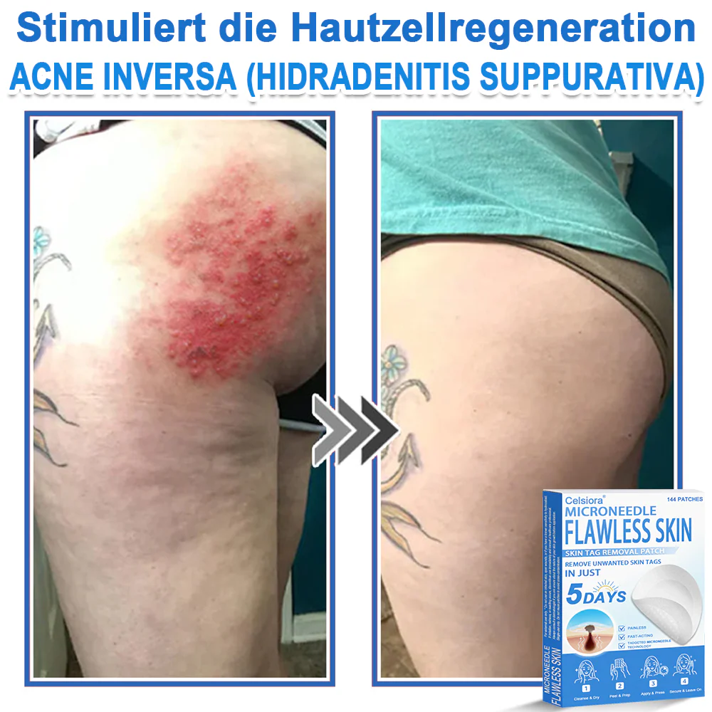 ✅ Celsiora® 2-in-1 Mikronadel- & Hydrokolloid-Pflaster | Entferner für erhabene Muttermale, Akne, flache Warzen & Hautanhängsel | Verbessert Falten, Narben & Hautunreinheiten | Unsichtbare Stern-Pickelpflaster für Gesicht & Körper✨ - Image 11