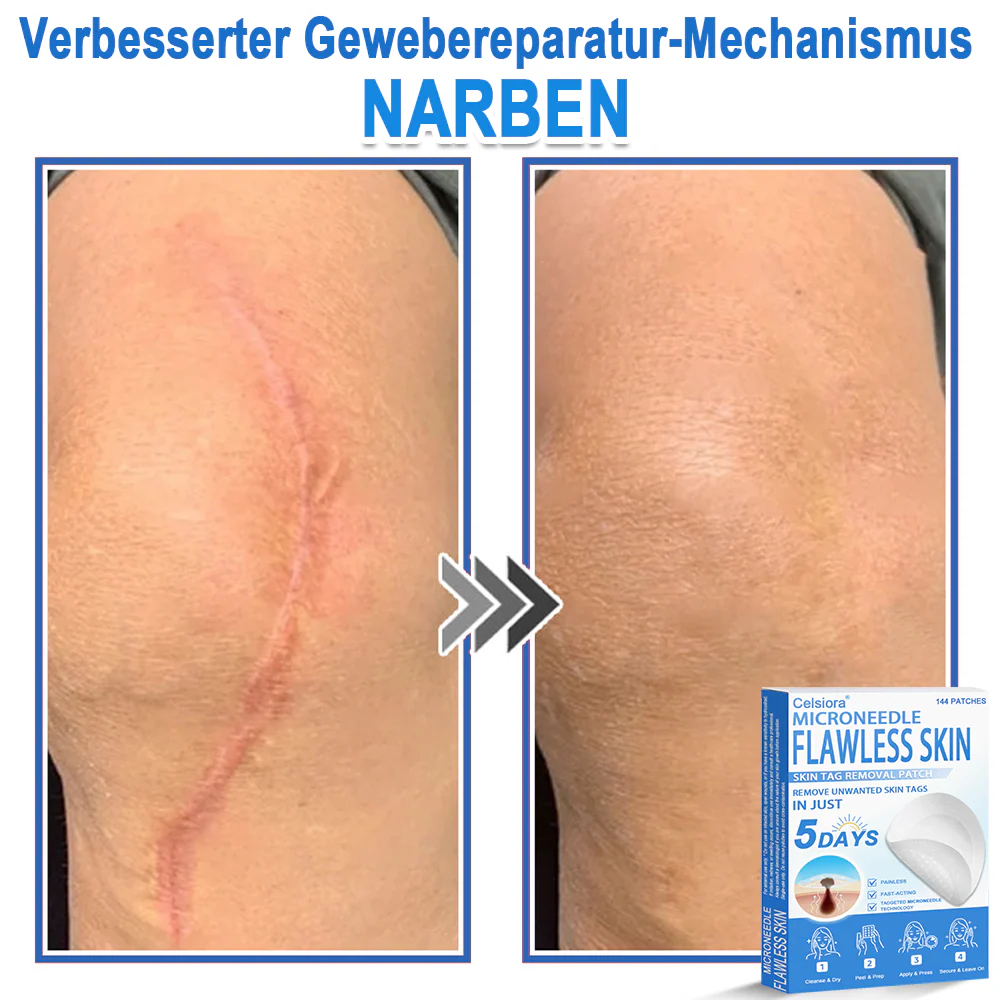 ✅ Celsiora® 2-in-1 Mikronadel- & Hydrokolloid-Pflaster | Entferner für erhabene Muttermale, Akne, flache Warzen & Hautanhängsel | Verbessert Falten, Narben & Hautunreinheiten | Unsichtbare Stern-Pickelpflaster für Gesicht & Körper✨ - Image 12