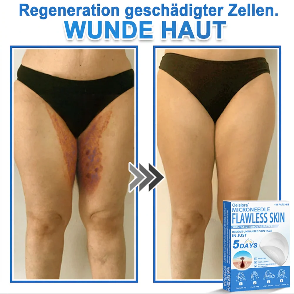 ✅ Celsiora® 2-in-1 Mikronadel- & Hydrokolloid-Pflaster | Entferner für erhabene Muttermale, Akne, flache Warzen & Hautanhängsel | Verbessert Falten, Narben & Hautunreinheiten | Unsichtbare Stern-Pickelpflaster für Gesicht & Körper✨ - Image 3