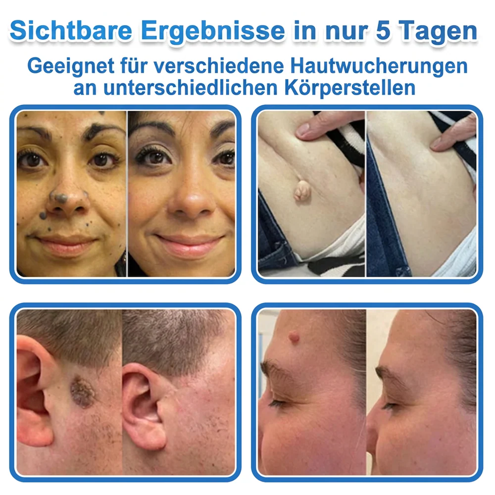 ✅ Celsiora® 2-in-1 Mikronadel- & Hydrokolloid-Pflaster | Entferner für erhabene Muttermale, Akne, flache Warzen & Hautanhängsel | Verbessert Falten, Narben & Hautunreinheiten | Unsichtbare Stern-Pickelpflaster für Gesicht & Körper✨ - Image 4