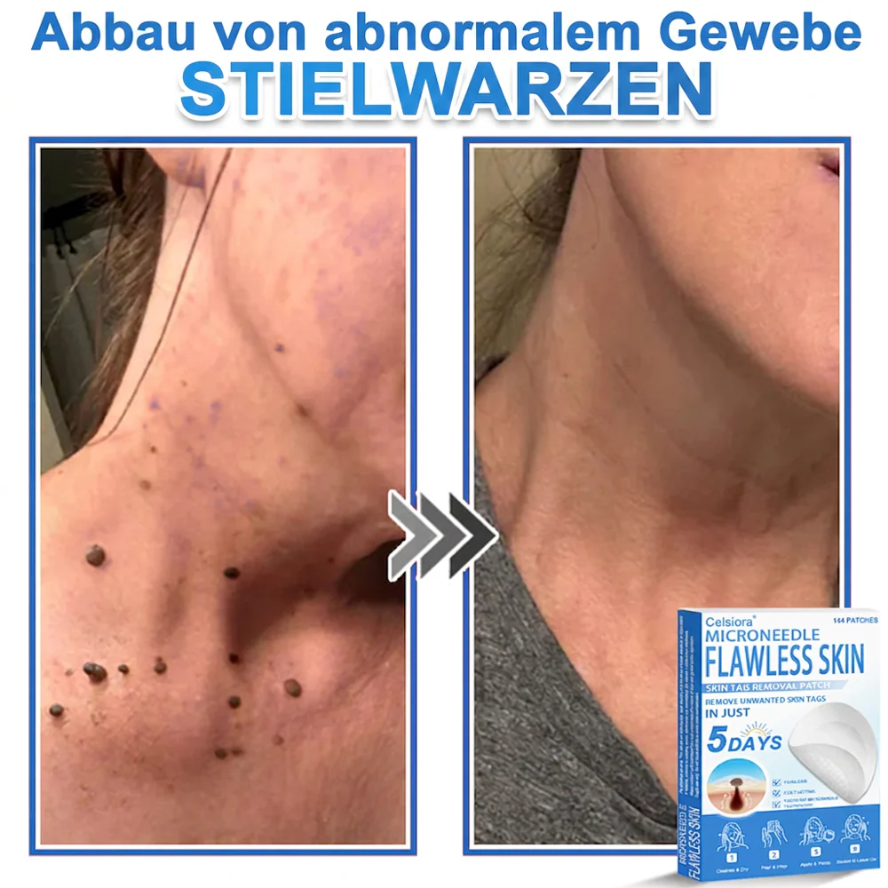 ✅ Celsiora® 2-in-1 Mikronadel- & Hydrokolloid-Pflaster | Entferner für erhabene Muttermale, Akne, flache Warzen & Hautanhängsel | Verbessert Falten, Narben & Hautunreinheiten | Unsichtbare Stern-Pickelpflaster für Gesicht & Körper✨ - Image 5