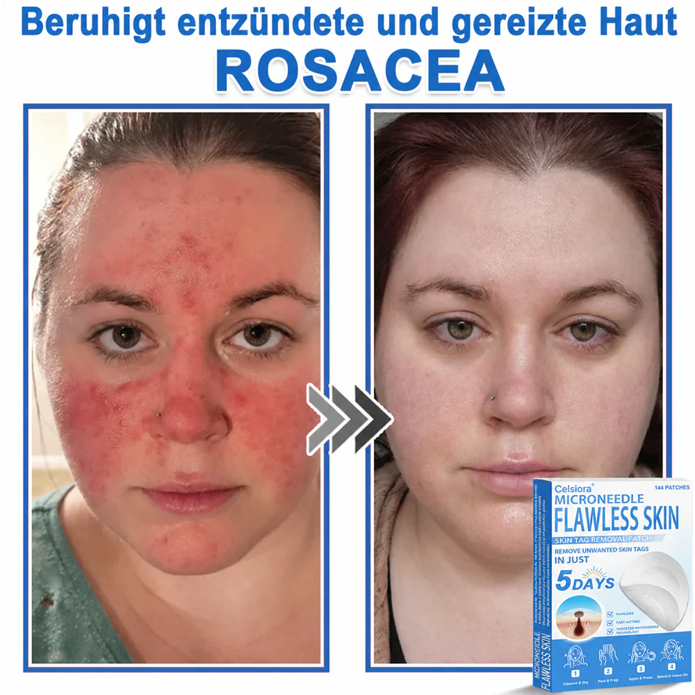 ✅ Celsiora® 2-in-1 Mikronadel- & Hydrokolloid-Pflaster | Entferner für erhabene Muttermale, Akne, flache Warzen & Hautanhängsel | Verbessert Falten, Narben & Hautunreinheiten | Unsichtbare Stern-Pickelpflaster für Gesicht & Körper✨ - Image 6
