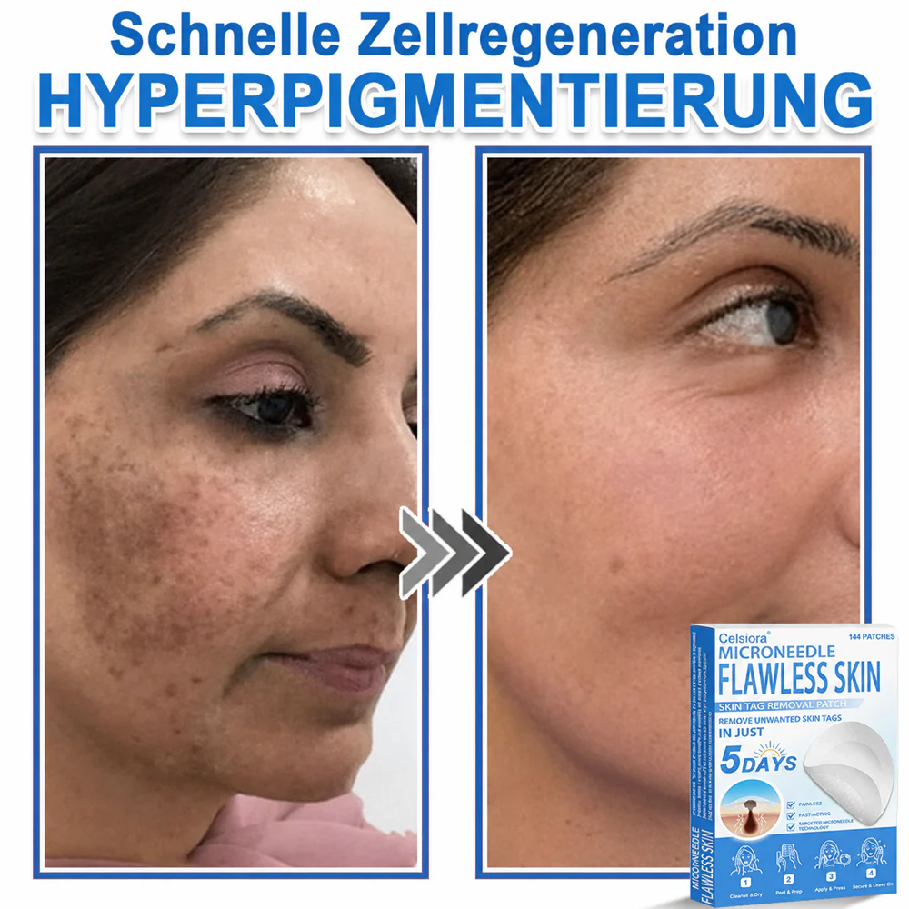 ✅ Celsiora® 2-in-1 Mikronadel- & Hydrokolloid-Pflaster | Entferner für erhabene Muttermale, Akne, flache Warzen & Hautanhängsel | Verbessert Falten, Narben & Hautunreinheiten | Unsichtbare Stern-Pickelpflaster für Gesicht & Körper✨ - Image 8