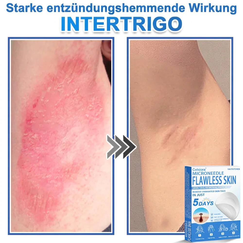 ✅ Celsiora® 2-in-1 Mikronadel- & Hydrokolloid-Pflaster | Entferner für erhabene Muttermale, Akne, flache Warzen & Hautanhängsel | Verbessert Falten, Narben & Hautunreinheiten | Unsichtbare Stern-Pickelpflaster für Gesicht & Körper✨ - Image 9